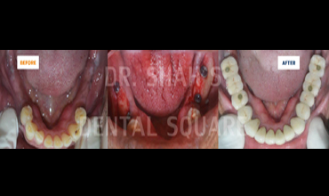 Implant Supported Bridge