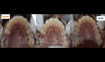 Single Tooth Replaced