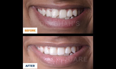 Single Tooth Replaced