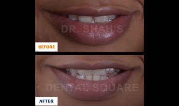 Single Tooth Replaced