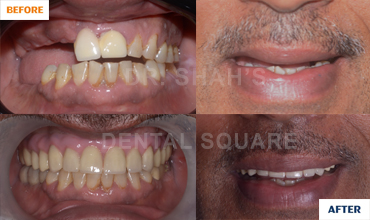 Single Tooth Replaced