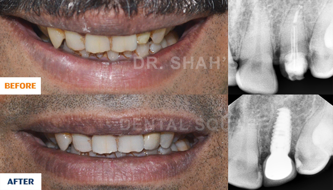 Single Tooth Replaced