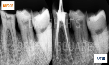 Root Canal