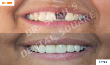 Esthetic Rehabilitation