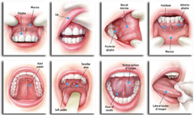 Oral Cancer