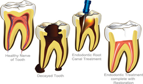 Root Canal